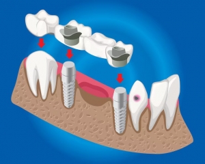 How Do Dental Implants Enhance Your Appearance? How Do Dental Implants Enhance Your Appearance?